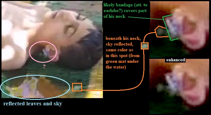 Khan Sheikhoun neck bandage.jpg