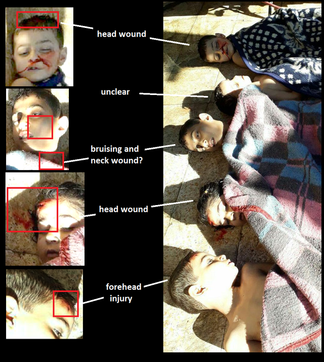 CW Khan Sheikhoun 2017 head wounds 1.png