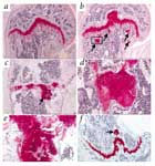 Enchondromatosis.jpg