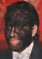 congenital hypertrichosis