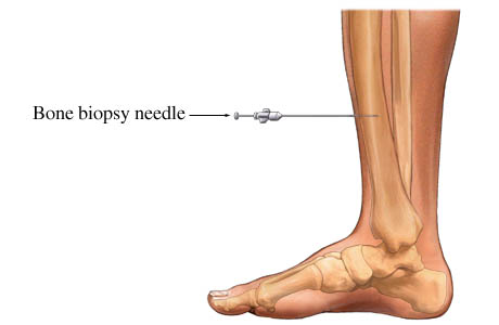 Bone biopsy.jpg