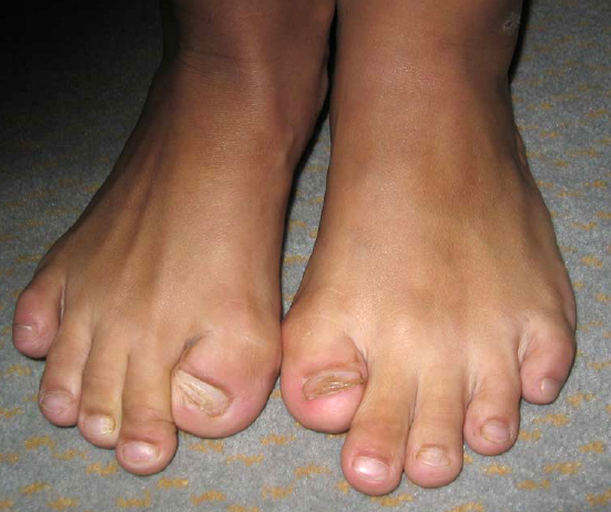 Toe.jpg