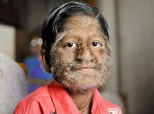 Werewolf syndrome