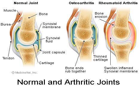 Arthritic joints.jpg