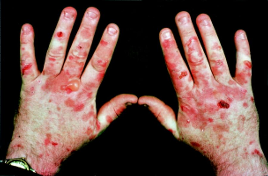 Cutaneous Porphyria (Vampires Disease) - AU Science Wiki